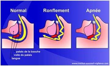 Traitement de l'apnée du sommeil à domicile en Finistère et Bretagne